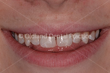 Cosmetic Dentistry - After