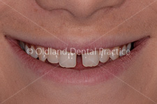 Cosmetic Dentistry - Before