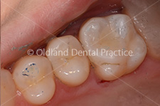 Cosmetic Dentistry - After